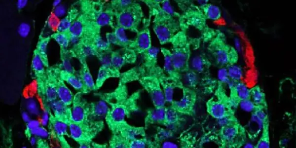 Rare Form Of Diabetes May Require Alternate Treatment