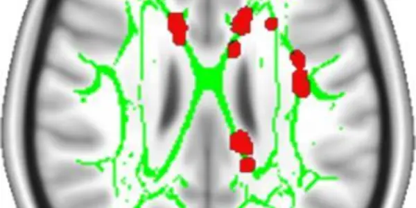 Brain May Be Hard-Wired For Chronic Pain