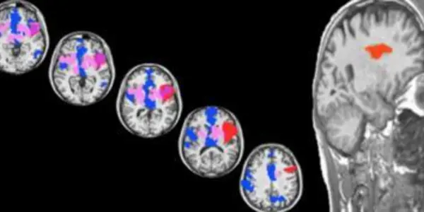 Stroke Victim Brain Imaging Finds Anterior Insula Is The 'Sweet Spot' For Love
