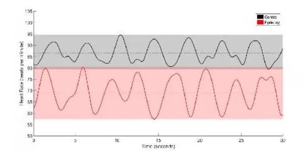Changes In Heart Activity May Signal Epilepsy