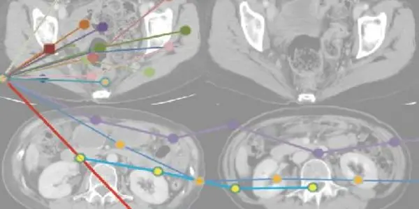 Stopping Ovarian Cancer In Its Tracks: An Antibody May Help Patients Heal Themselves