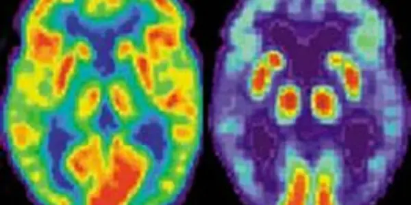 New screening criteria proposed for Alzheimer's