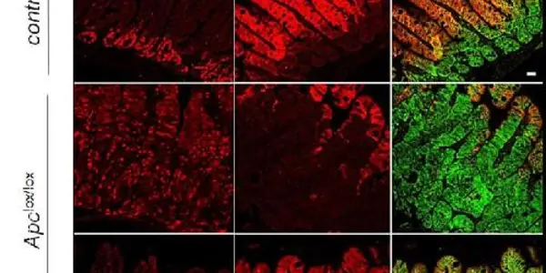 Treating Colon Cancer With Vitamin A