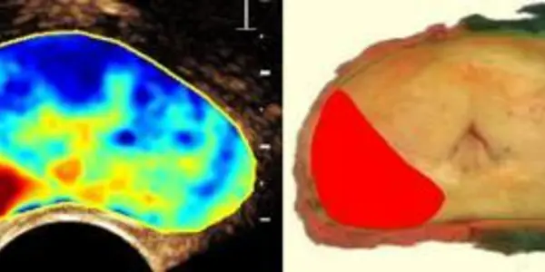 New Prostate Cancer Detection Can Save Millions Of Men From Painful Biopsies