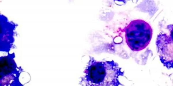 Antihistamines May Become A Cancer Therapy