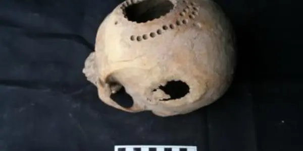 Ancient Peruvian Heartbreak Therapy: Skull Drilling
