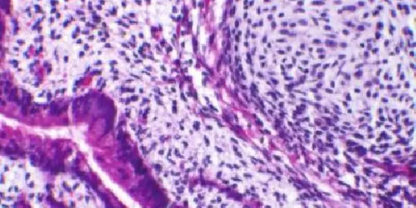 Scientists Identify Molecule That Appears To Fuel Deadly Genetic Illness