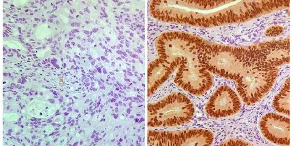 Biomarker Predicts Which Stage II Colon Cancer Patients May Benefit From Chemotherapy