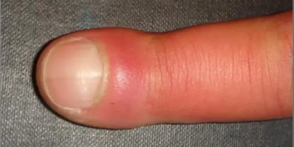 Researchers Say PGE2 Is Behind The Puzzling Medical Condition 'Finger Clubbing'