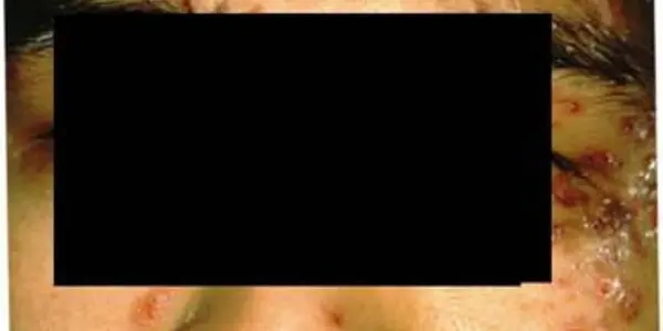 'Scrumpox' Herpes Virus Not Just Rugby - Now Sumo Wrestlers Get It Too