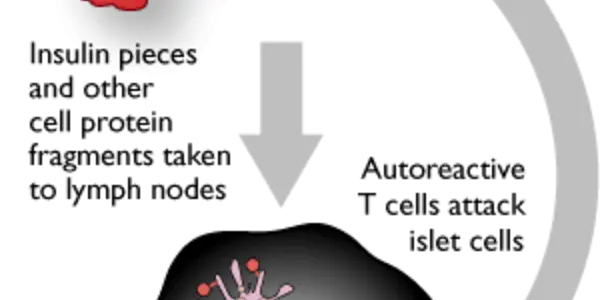 Developing a Vaccine for Type 1 Diabetes