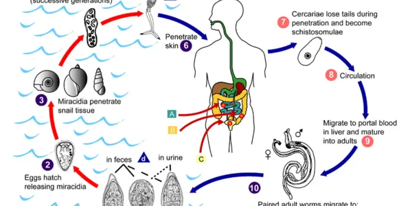 Schistosomiasis- New Urine Test Could Help Millions