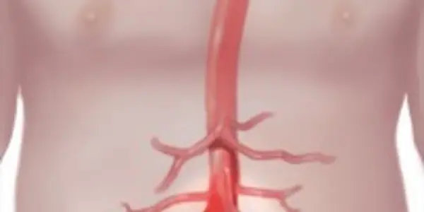 Abdominal Aortic Aneurysms: Who Needs Screening And Treatment