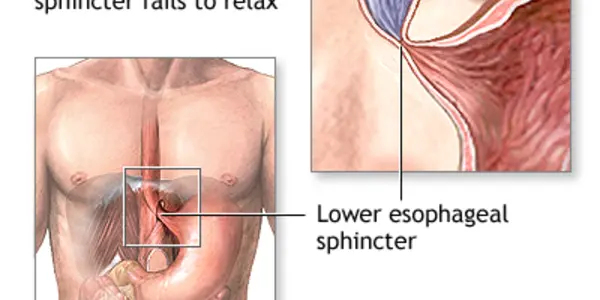 Achalasia Esophagus Disease Is Autoimmune