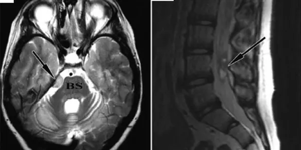 Case Study - Brain And Spinal Tumor Following Stem Cell Therapy