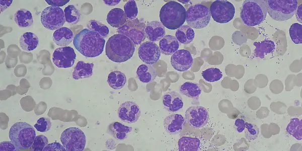 Mathematical Model Gives New Hope To Chronic Myeloid Leukaemia Patients