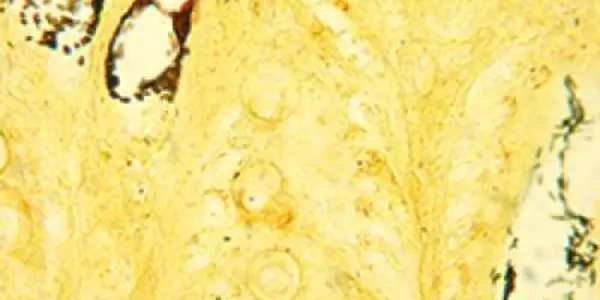Sometimes Good Gut Bacteria Get Sick