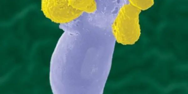 13 Year Old Finds Fungus Deadly To AIDS Patients