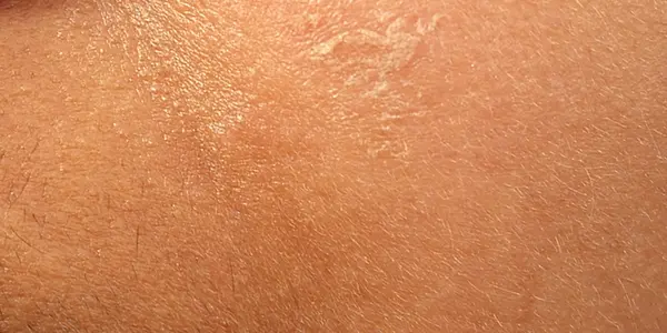 Sunburn with Sunscreen - A Case Study