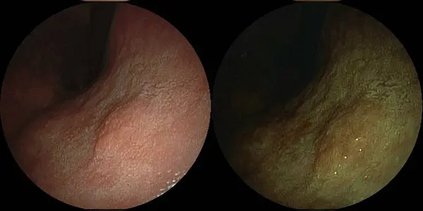 Marker That Identifies Stomach Cancer With Different Progressions Discovered