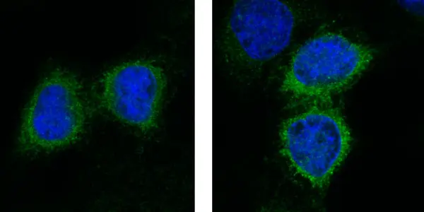 Lung Cancer - Even If You Can't Prevent It, There May Be A Better Way To Kill It