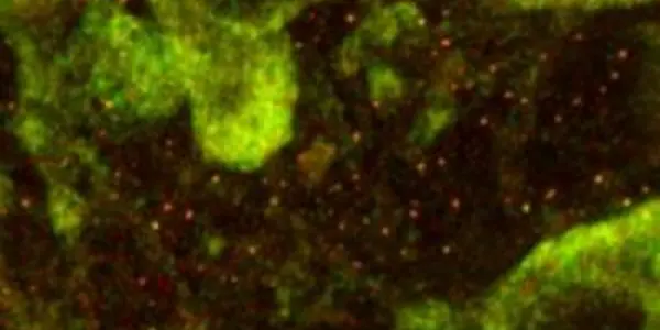 Fragile X Granule Could Lead To New Autism Treatment