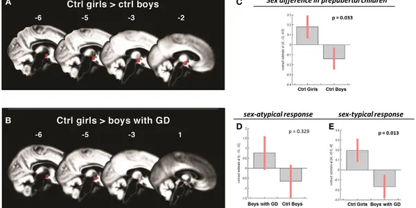 Gender Dysphoria: Brain Reaction To Male Odor Shifts At Puberty