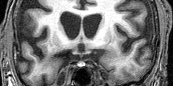 Researchers find a protective pathway that delays Huntington's symptoms