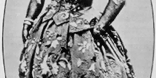 Congenital Generalized Hypertrichosis Terminalis - Why The Bearded Lady Was Bearded