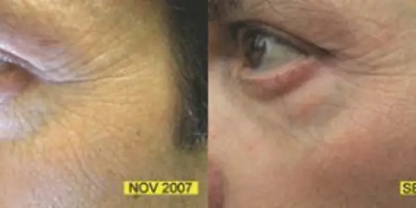Bye Bye Botox - LEDs May Help Reduce Skin Wrinkles
