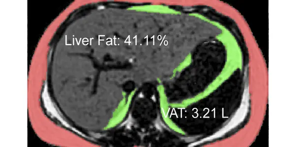 High Fructose Corn Syrup, Genes And Global Trade Policy:  A “Perfect Storm” For Fatty Liver Disease In Hispanics