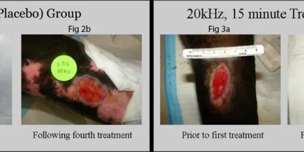 Clinical Trial: Ultrasound Band-Aid Heals Venous Ulcers
