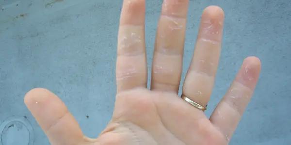 Squid Sucker Rings Can Hurt (A Little)