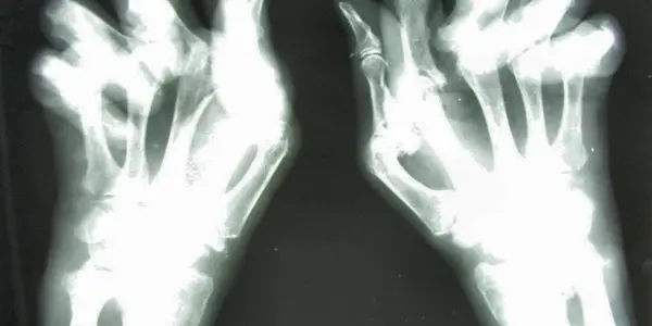 Rheumatoid Arthritis - Can New Treatment Spell The Beginning Of A Cure?