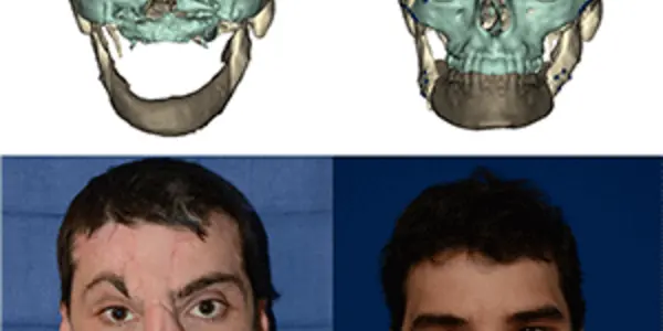 2030 - Get Ready For Common Facial Transplantation