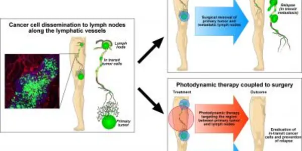 Photodynamic Therapy For Cancer?