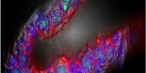 Some Aggressive Cancers Respond To Arthritis Drugs