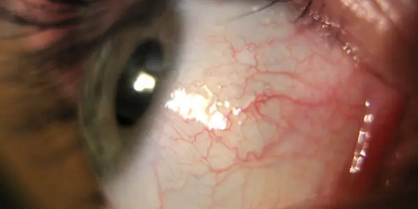 This Eye-Opening Parasite Can Get In Through Your Contact Lens