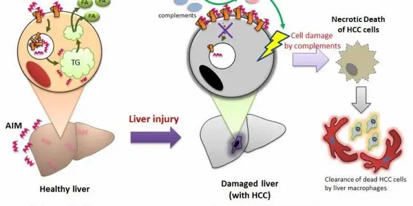Apoptosis Inhibitor Of Macrophage Stops Liver Cancer In Its Tracks