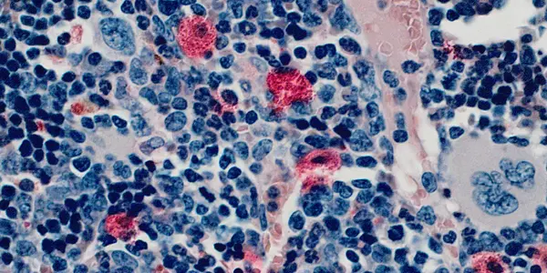 Fighting Resistant Blood Cancer Cells In Leukemia