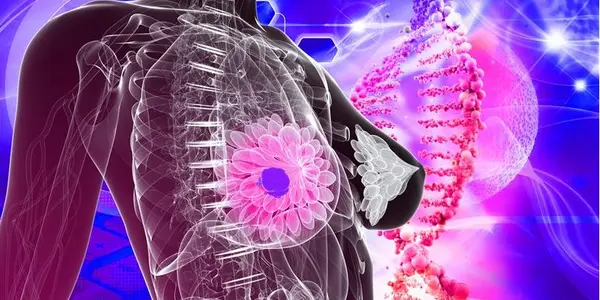How Did Mexico Eliminate Breast Cancer Deaths?