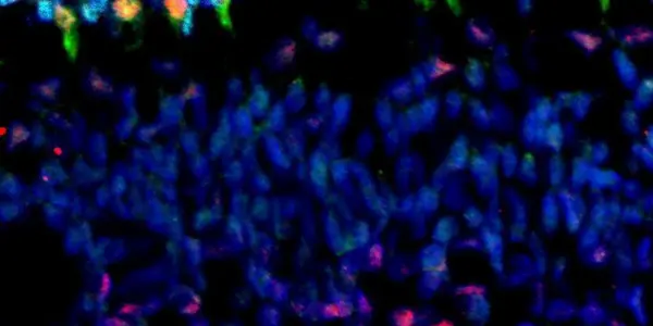Why RB1 Gene Is Linked To Retinal Tumors In Young Children