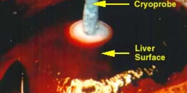 Killing Cancer With Cold: Cryoablation Technology Studied For Use Against Invasive Breast Carcinoma