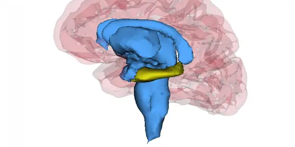 Patients With Recurrent Depression Have Smaller Hippocampi