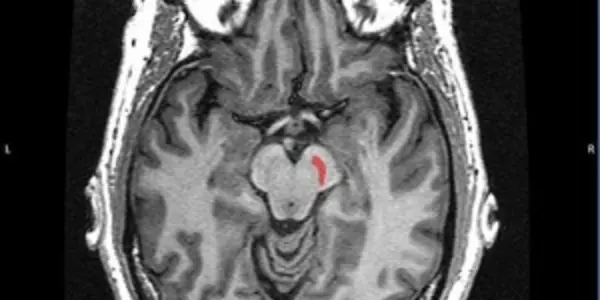 Europe Reinvestigates Fetal Cell Transplants For Parkinson’s Disease