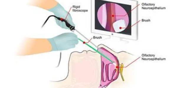 Nasal Brush Test For Creutzfeldt-Jakob Disease
