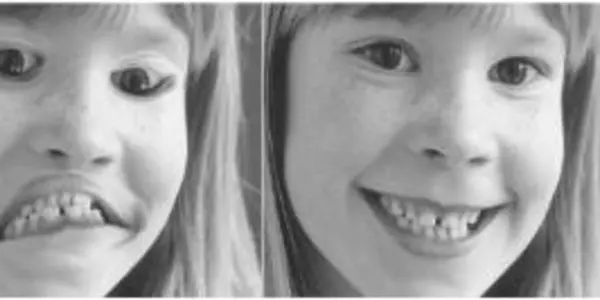 What Funny Faces Can Tell Us About Schizophrenia