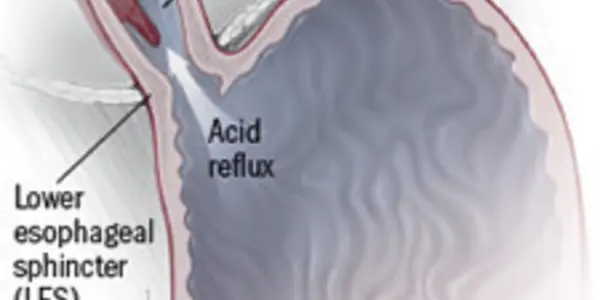 The Link Between Stomach Woes And Bad Breath