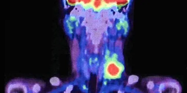 Number Of Immune Cells In Tumors Could Soon Help Predict And Treat Cancers
