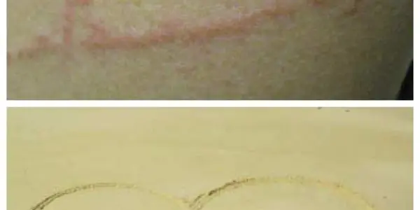 Jellyfish-induced Lesions In Brazil